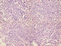 Indolent-Tcell-Lymphoproliferative-Disorder-HE-High-Power