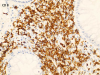 Indolent-Tcell-Lymphoproliferative-Disorder-CD8