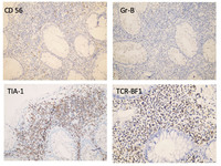 Indolent-Tcell-Lymphoproliferative-Disorder-CD56-Gr8-TIA1--TCRBF1