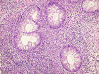 Indolent-Tcell-Lymphoproliferative-Disorder-HE-High-Power