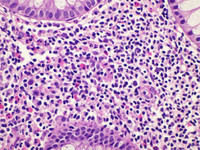 Indolent-Tcell-Lymphoproliferative-Disorder-HE-High-Power