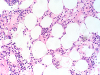 Hairy cell leukemia involving bone marrow, Cyclin D1 positive
