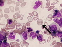 Cabot ring in Chronic Myeloid Leukemia