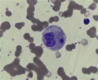 Hemophagocytic activity in peripheral blood of a patient with autoimmune hemolytic anemia