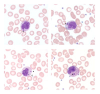 Howell-Jolly body-like inclusions in neutrophils