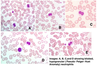 Pseudo-Pelger-Huet Anomaly: Peripheral Smear