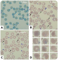 Numerous Heinz bodies in a case of infantile pyknocytosis