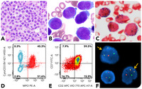Microgranular acute promyelocytic leukemia with expression of T-cell markers mimicking mixed-phenotype acute leukemia