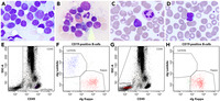 CD45-negative follicular lymphoma