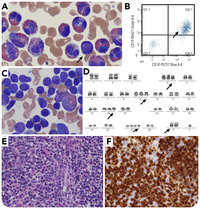 Hyperdiploid B-lymphoblastic leukemia/lymphoma with hypereosinophilia and very few circulating lymphoblasts