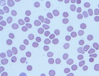 Human babesiosis