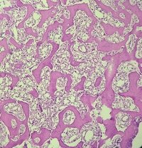 PAGET'S DISEASE OF BONE 2