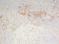 Littoral-cell-angioma-CD21