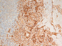 Littoral-cell-angioma-CD31