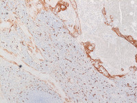 Littoral-cell-angioma-CD34