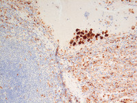 Littoral-cell-angioma-CD68