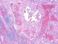 Littoral-cell-angioma-HE