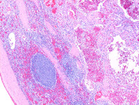 Littoral-cell-angioma-HE