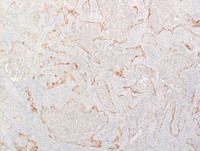 Littoral-cell-angioma-Langerin