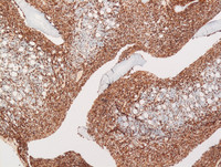 Transformed-follicular-lymphomaBone-marrowCD10