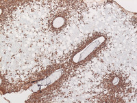 Transformed-follicular-lymphomaBone-marrowCD20