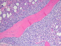 Transformed-Follicular-lymphomaBone-marrow-biopsy-HE