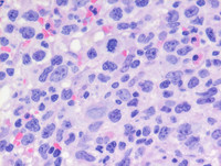 Transformed-Follicular-lymphomaBone-marrow-biopsy-HE