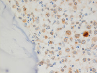 Transformed-Follicular-lymphoma-Bone-marrowKi67