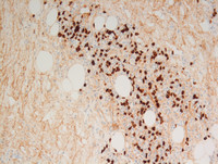 Extranodal-RosaiDorfman-disease-IgG4