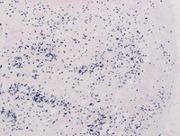 Extranodal-RosaiDorfman-disease-Lambda