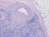 Isolated breast involvement by extranodal Rosai-Dorfman disease