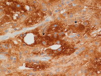 Extranodal-RosaiDorfman-disease-S100