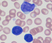 Sezary-syndromePeripheral-blood-smear