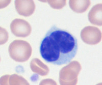 Sezary-syndromePeripheral-blood-smear