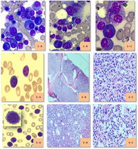Morphological variants of plasma cell myeloma cases 1-3
