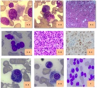 Morphological variants of plasma cell myeloma cases 4-7