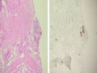 NON NEOPLASTIC GLANDS IN BONE MARROW TREPHINE BIOPSY 1