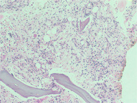 Figure 04: Bone marrow trephine biopsy showing focal interstitial aggregates and singly dispersed large polygonal cells(x400)