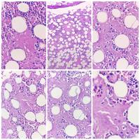Bone marrow biopsy involvement by amyloidosis 1