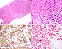 Crystal-Storing Histiocytosis