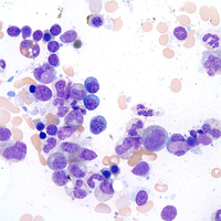 "Tart" cells": monocytes with intracytoplasmic phagocytized nuclear material. Wright-Giemsa stain. Ob. 100x immersion oil