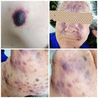 Leukemia cutis in acute myeloid leukemia - 1