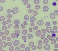 Pyruvate kinase deficiency -Peripheral smear showing target cells, polychromatophilic cells, nRBC and prickle cells (x1000)