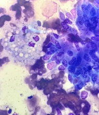 Pulmonary Cryptococcoma in an immunocompetent patient with suspected lung malignancy – A tumor mimicker and diagnostic challenge