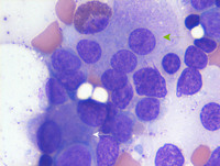 AML-with-myelodysplasia-related-changes-Bone-marrow-aspirate
