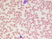 AML-with-myelodysplasia-related-changes-Peripheral-blood-smear