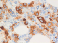 AML-with-myelodysplasia-related-changes-Bone-marrow-biopsyCD61