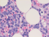 AML-with-myelodysplasia-related-changes-Bone-marrow-biopsy-HE