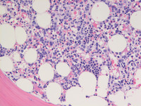 AML-with-myelodysplasia-related-changes-Bone-marrow-biopsy-HE