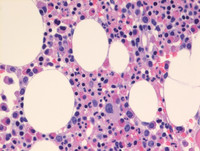 Lymphocytic-variant-of-HES-Bone-marrow-biopsy